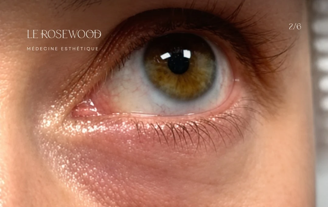 Close-up of the under-eye area and its natural shadows