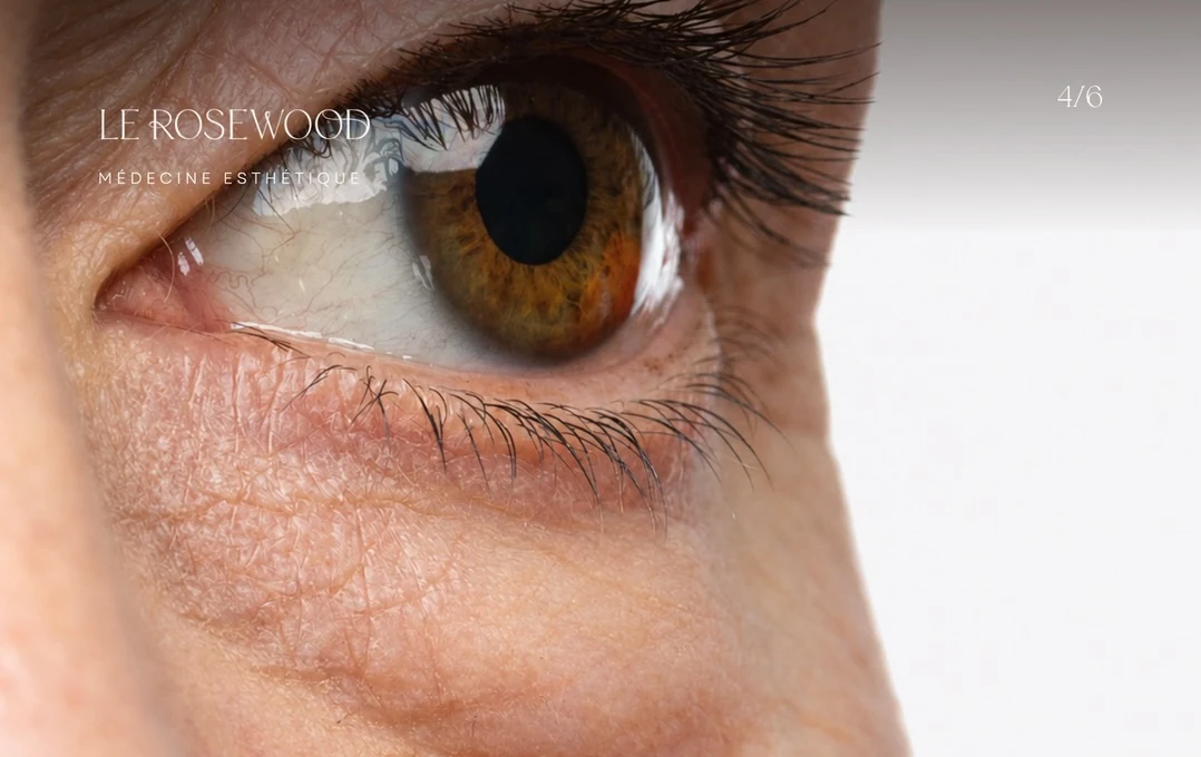 Close-up of the lower eyelid and cheek